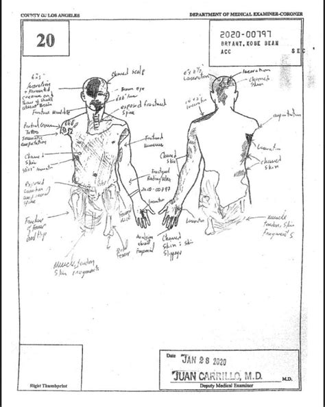 gigi autopsy sketch|Kobe Crash Autopsy Reports : r/CrimeScene